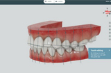 3D打印在齿科的应用：几乎所有产品都使用3D打印