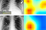 VisionPro Deep Learning软件能够识别胸部X光片图像中的新型冠状病毒