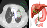 临床前沿：使用精准放疗“炸弹”靶向治疗肝脏肿瘤